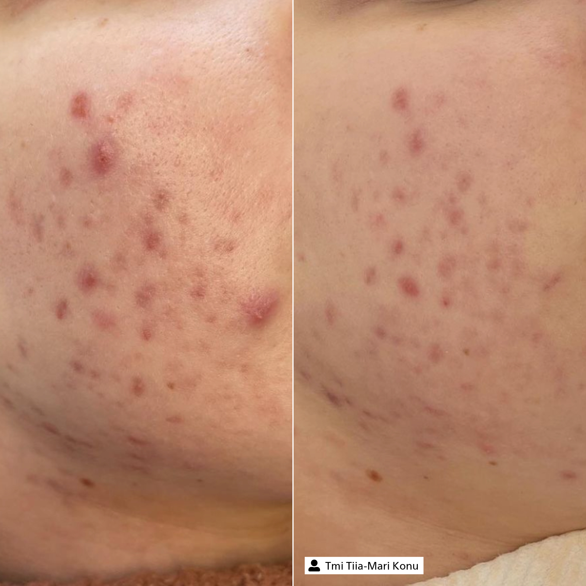 Blemish Control Serum
