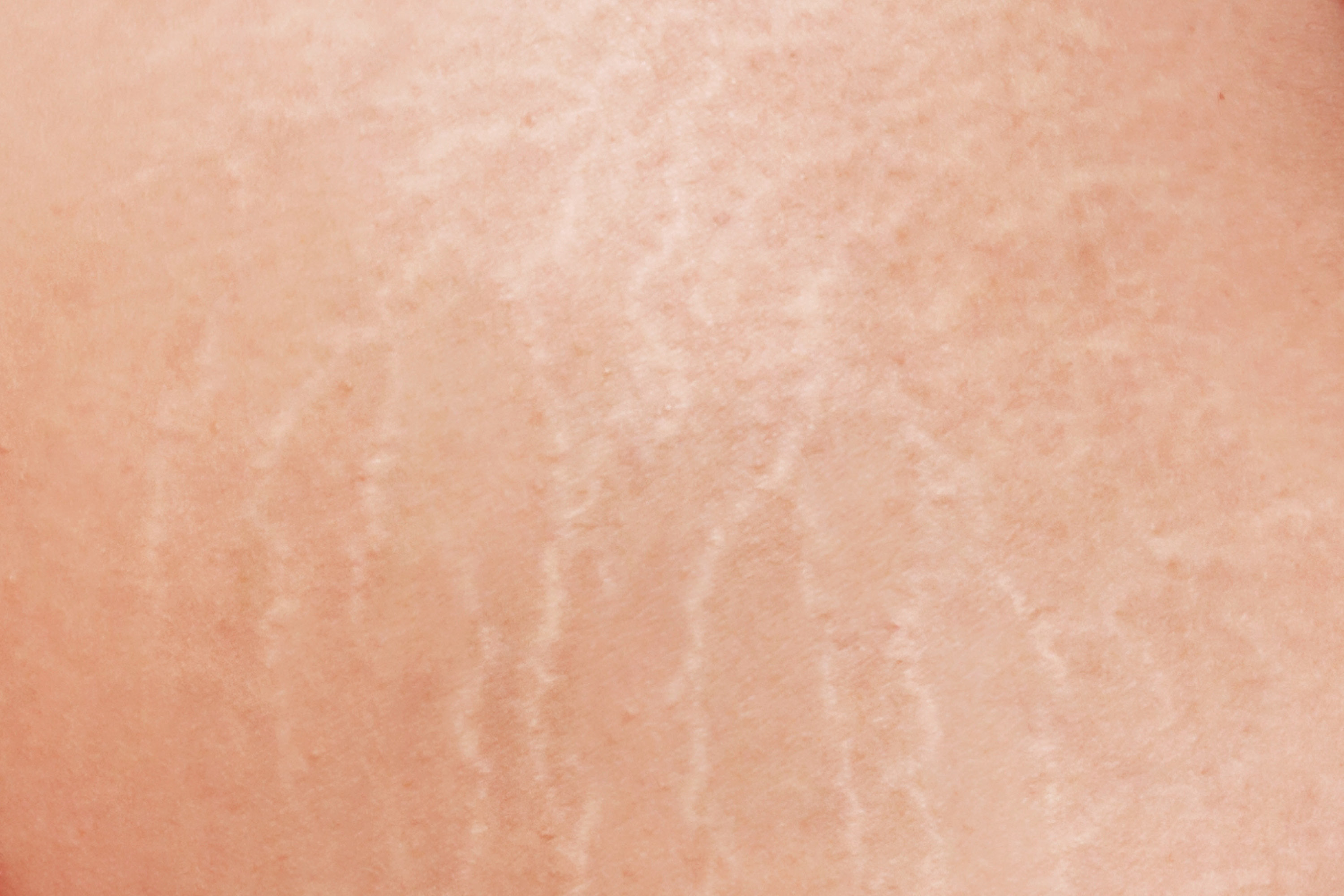 dsr_category_stretch_marks_1