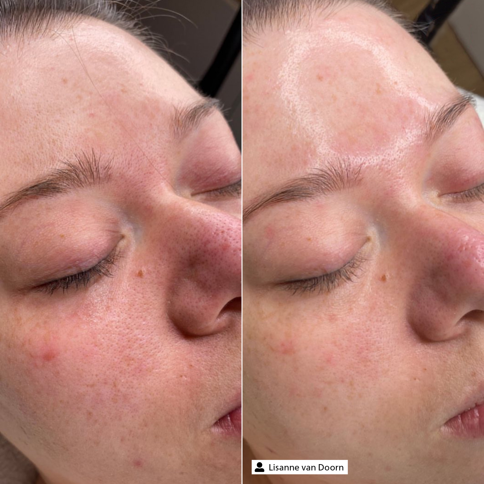 BHA Exfoliator
